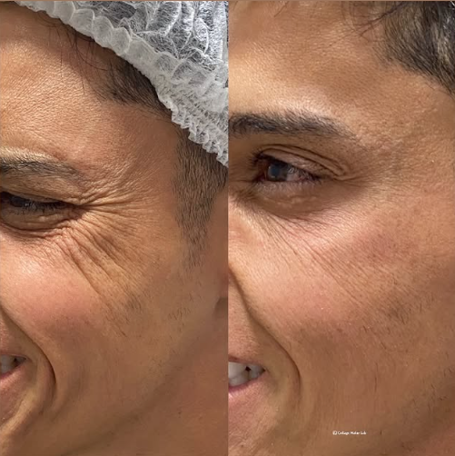 Tratamento de Rugas